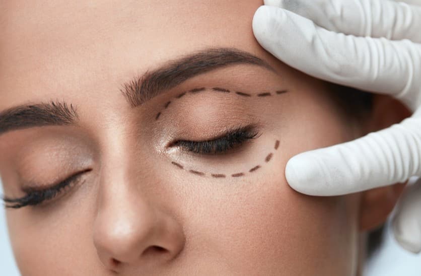 blefaroplastica-palpebre-cadenti