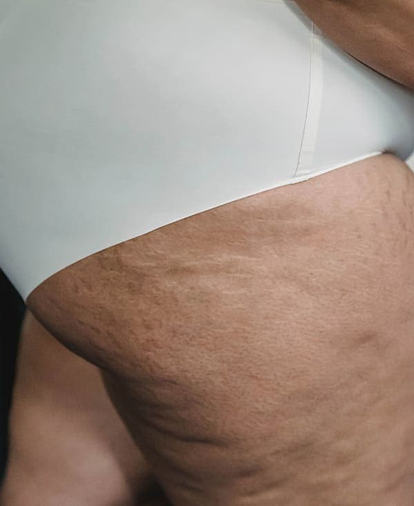 Riduzione della Cellulite