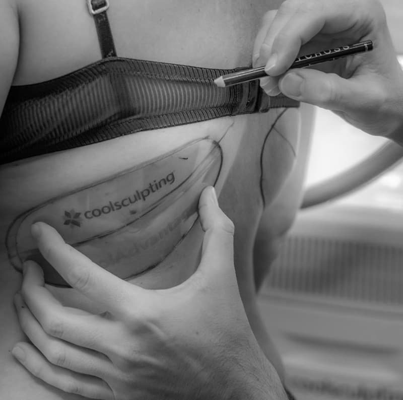 Q&A: Coolsculpting è paragonabile alla liposuzione?
