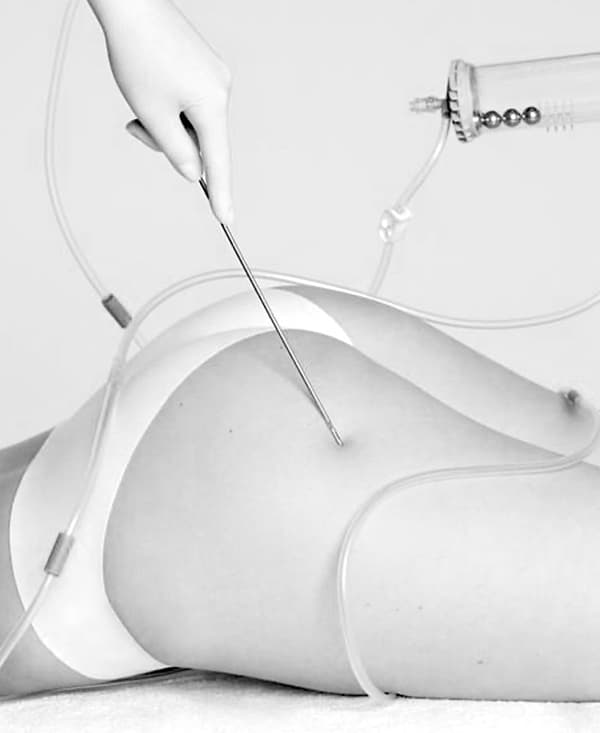 Testimonianza: Lipoaspirazione o Liposuzione? La differenza