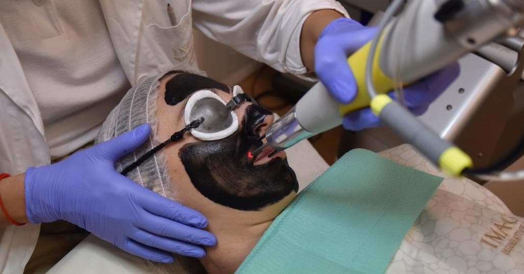 Novità: Carbon Peel Laser