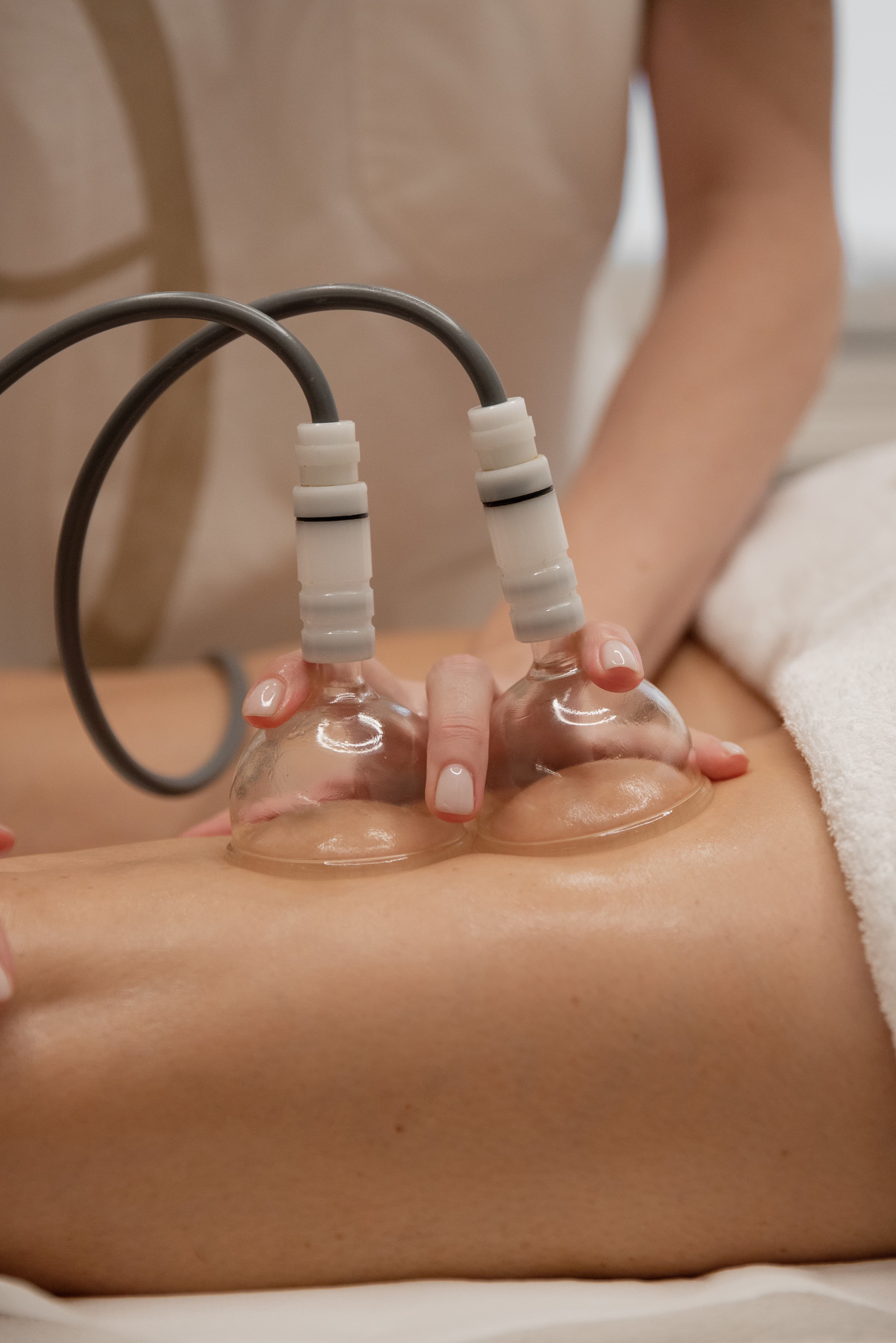 Cupping Therapy: What It Is, How It Works, and What It's For