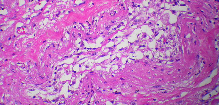 Lipogems ortopedico – La nuova frontiera in medicina dello sport