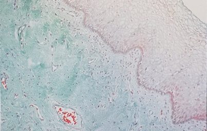 Lipogems for Urogenital Atrophy Treatment - AICPE 2018